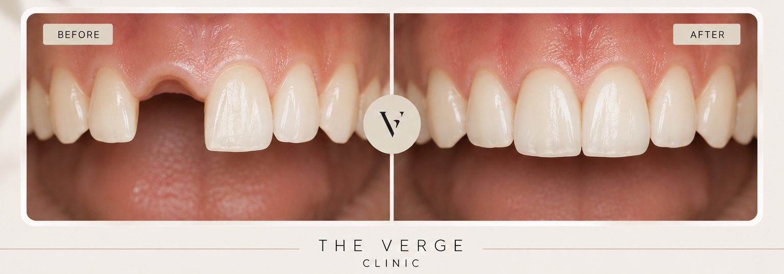 Dental implants at The Verge Clinic
