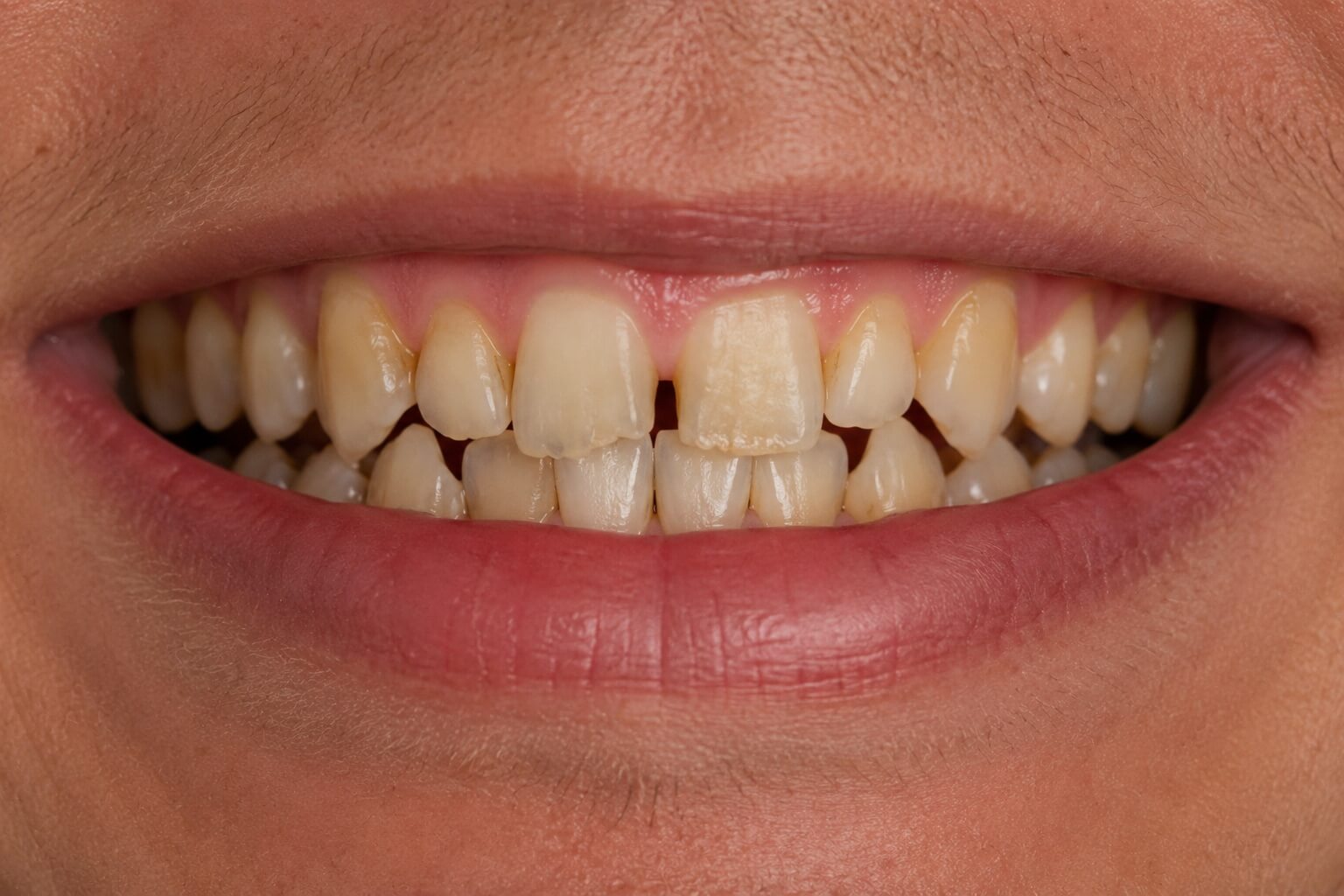 Real Before (1)