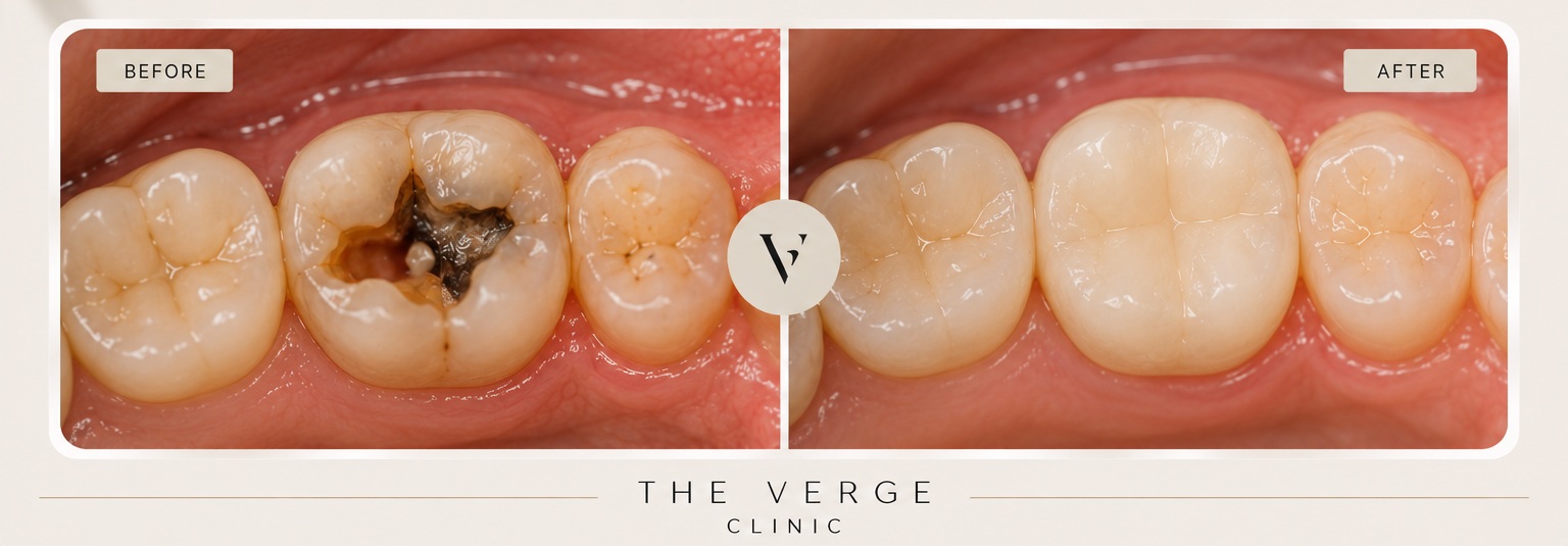 Root canal treatment at The Verge Clinic