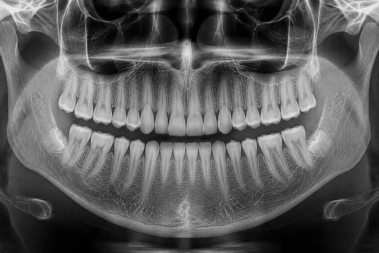 Xray After (1)