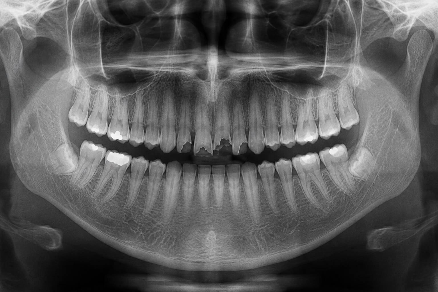 Xray before (1)